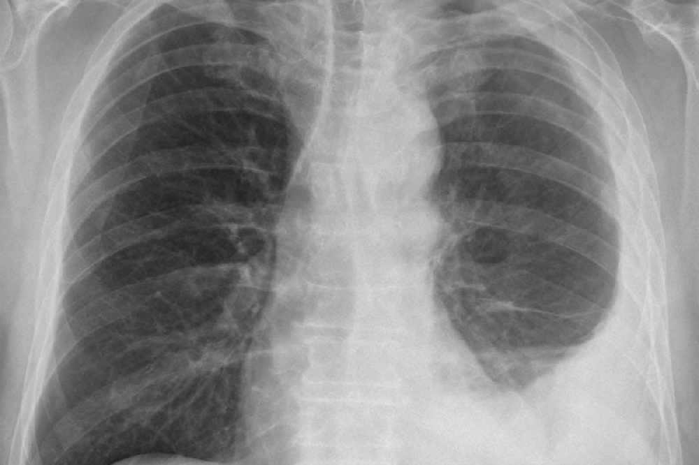 copd stage b